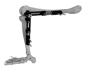 Knee external fixator system with straigth clamps